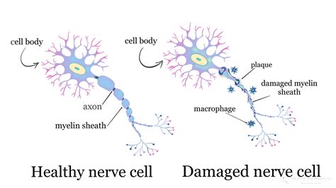 Multiple Sclerosis (MS): Causes, Symptoms, Diagnosis & Treatment ...