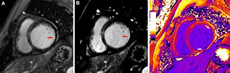 A typical case in which post-contrast T1 mapping improved the detection... | Download Scientific ...