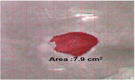 Hyperspectral image of coccyx sacrum pressure injury. Hyperspectral ...