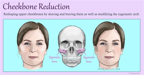 Facial Fat What Kind Of Corrective Procedure Or Surgery Is Right For