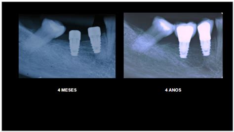 Caso Cl Nico Implantes Curtos Um Acompanhamento De Quatro Anos