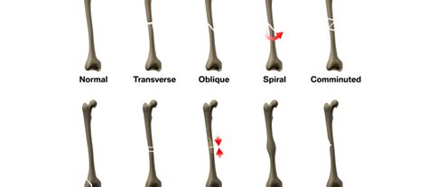 Comprehensive Guide To Understanding The Different Types Of Fractures