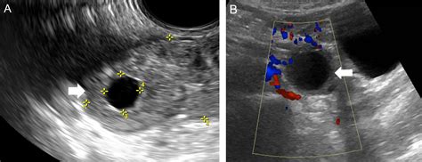 Magnetic Resonance Imaging In Tubal And Non Tubal Ectopic Pregnancy