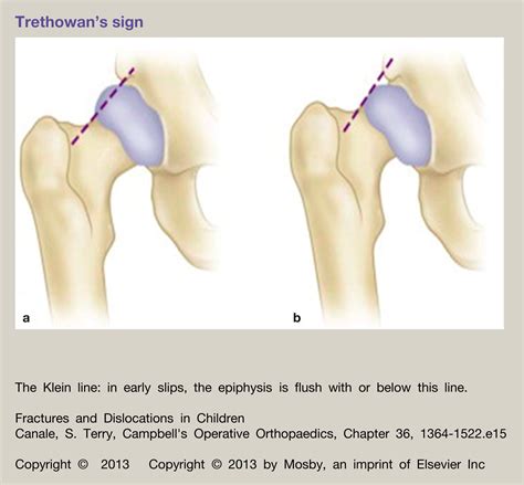 Slipped Upper Femoral Epiphysis Orthopaedics And Trauma