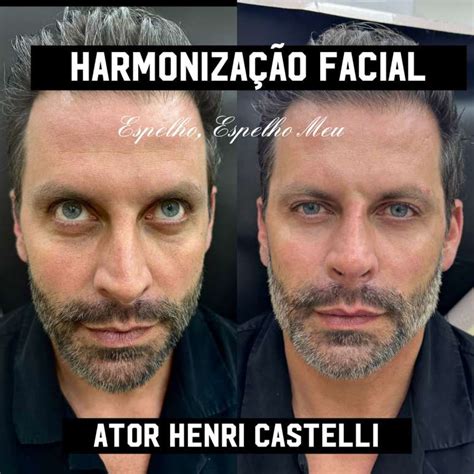 Henri Castelli Faz Harmoniza O Facial Veja O Antes E Depois