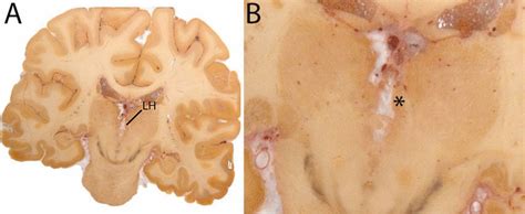 A The Habenula Lh Is A Small Structure Medial From The Tha And Download Scientific Diagram