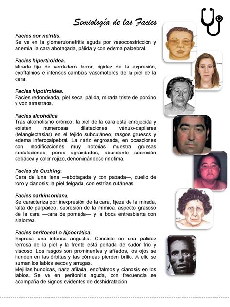 Facies Parkinsoniana