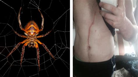 Spider burrows itself and lives inside man's body for three days - ABC7 ...