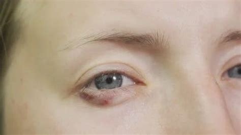 Allergy under the eye. Redness on the sk... | Stock Video | Pond5