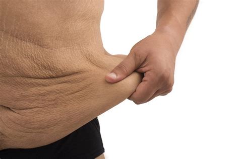 5 Things You Can Do To Prevent Loose Skin After Sleeve Gastrectomy Loose Skin Excess Skin