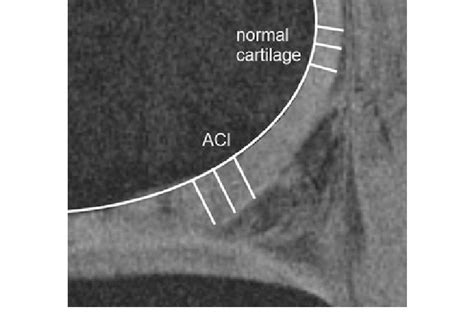 Knee Mri With Three Measuring Points Of Cartilage Thickness In The