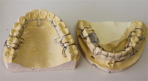 Treatment Of Tmj Alf Disorder Maribel M Vann Dds