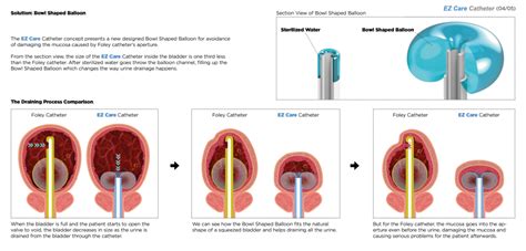 Foley Balloon Process For You