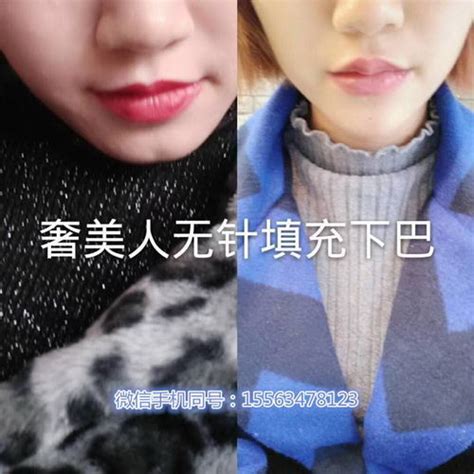 奢美人无针微整价格表奢美人无针祛皱哪里可以做？现代健康网