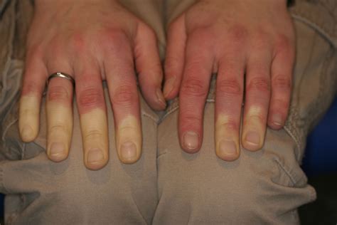 Raynaud Syndrom Doccheck Flexikon