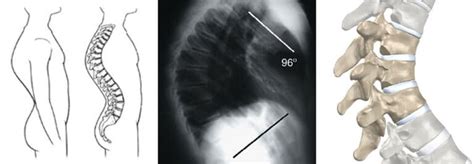 Scheuermanns Disease Spineplus