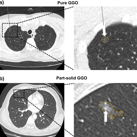 Pdf Invasiveness And Surgical Timing Evaluation By Clinical Features Of Ground‐glass Opacity