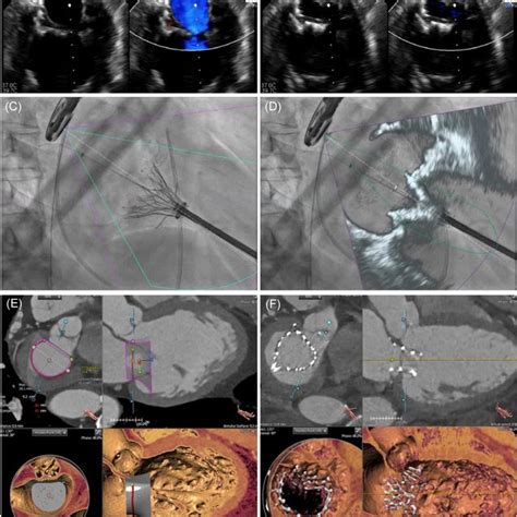 Valve‐in‐ring Transcatheter Mitral Valve Implantation With Lampoon