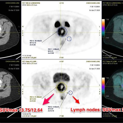 Pet Ct With Fdg Revealed An Fdg Avid Cervical Mass With Invasion Of