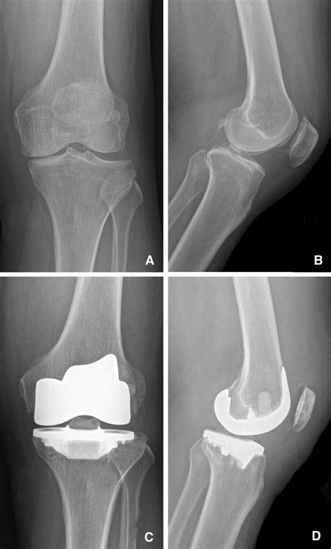 Pre And Post Operative Bicruciate Retaining Total Knee Arthroplasty