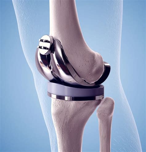 Centurion Orthopaedic Centre Minimally Invasive Knee Replacement