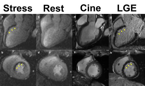 Is Stress Cmr Ready For Prime Time American College Of Cardiology