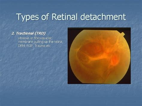 Management Of Retinal Detachment Dr Vincent Yauwing Lee