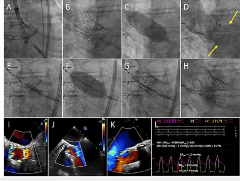 Figure 1 From Successful Rescue Transaortic Valve Replacement Using