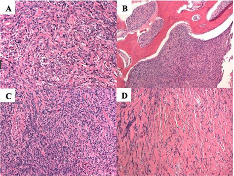 Solitary Fibrous Tumor Of The Nasal Cavity With Intracranial Expansion