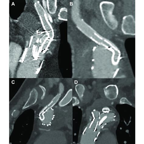 Postoperative Computed Tomography Angiography Cta At 1 And 6 Months Download Scientific