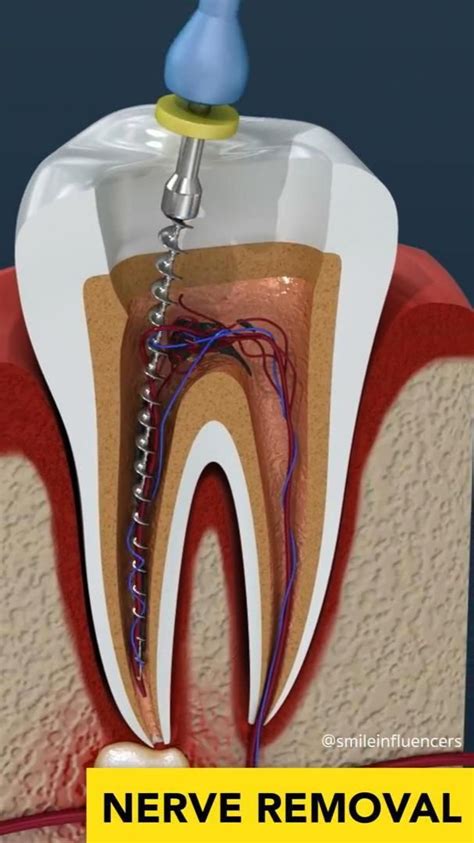 How To Heal Gums After A Tooth Extraction With Pictures Artofit