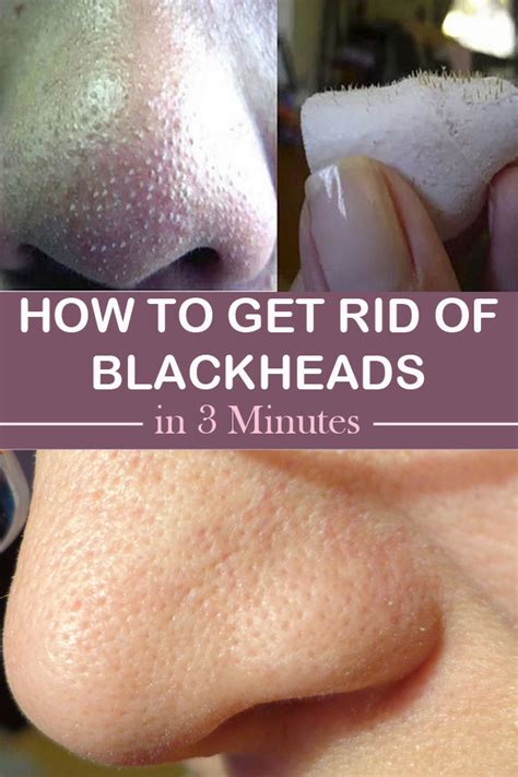 How To Get Rid Of Blackheads In 3 Minutes Beauty Enhancers