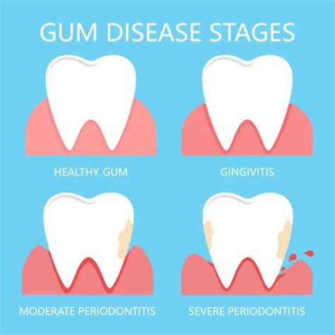 الفرق بين التهابات اللثة وأمراض اللثة Euro Dental Center