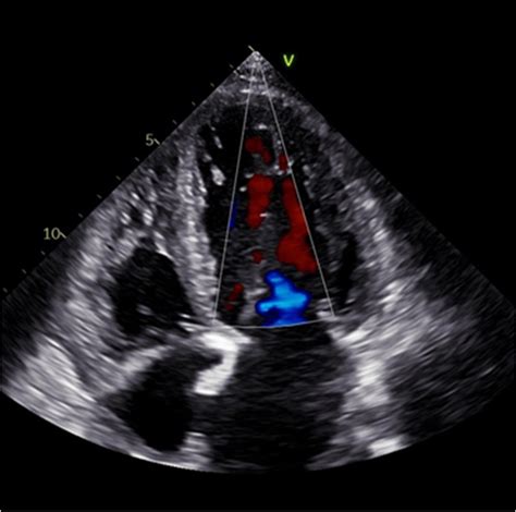 A Transthoracic Echocardiography Parasternal Short Axis View