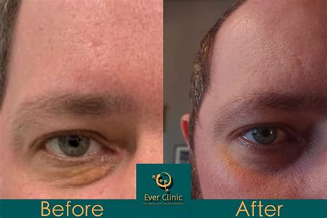 Xanthelasma Removal Glasgow Laser Treatment Clinic Scotland