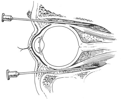 Peribulbar Injection