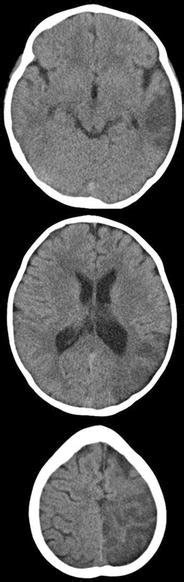 Initial Brain CT Images Taken 12 H After The Onset Of Stroke Axial