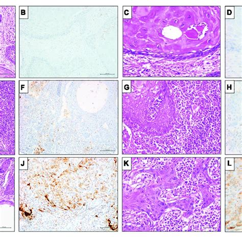 Representative Results Of Pd L1 Clone Sp263 Ihc Expression By Cps