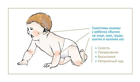 Атопический дерматит у грудничка: причины и лечение у новорожденных