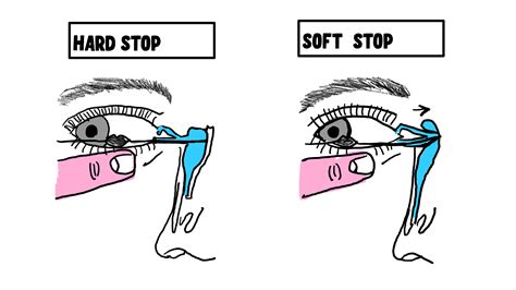 Lacrimal Syringing And Probing Made Incredibly Easy Insight Ophthalmology