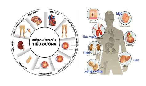 Bệnh Đái Tháo đường Và Những Biến Chứng Thường Gặp Trung TÂm Y TẾ Lai