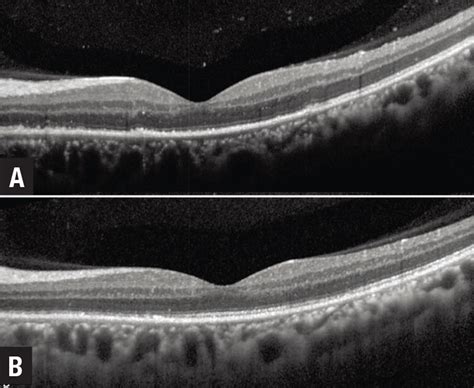 OCT Biomarkers In Uveitis An Update