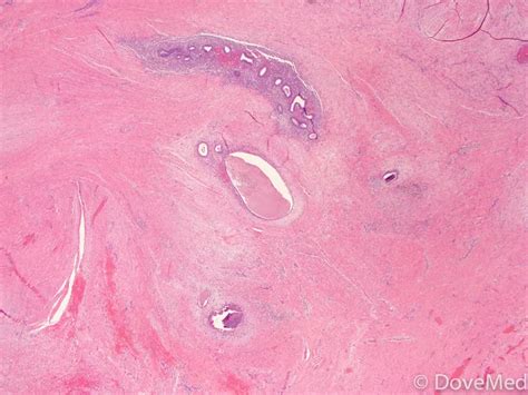 Endometriosis Of Vagina Dovemed