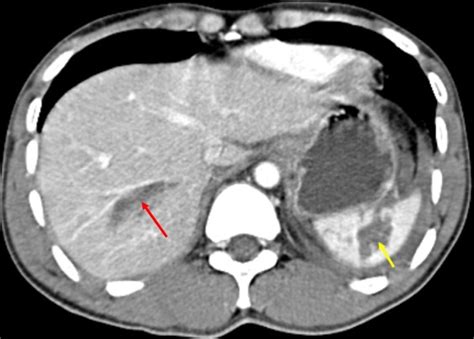 Blunt Liver And Spleen Injuries Ct Grading Versus Intra Operative