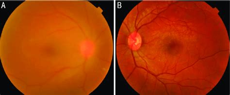 Colored Fundus Photos Of Both Eyes A Right Fundus Showing Dense Download Scientific Diagram