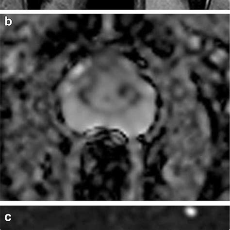 PI RADS III Prostate Cancer A Axial T2 WI Shows TZ Heterogeneous