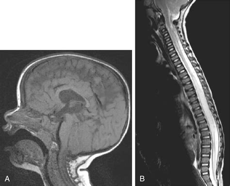 Chiari Malformations And Syringomyelia Clinical Tree