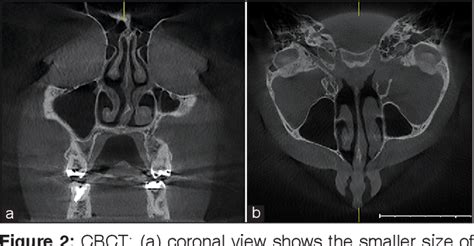 Figure 1 From Aplasia And Hypoplasia Of The Maxillary Sinus A Case