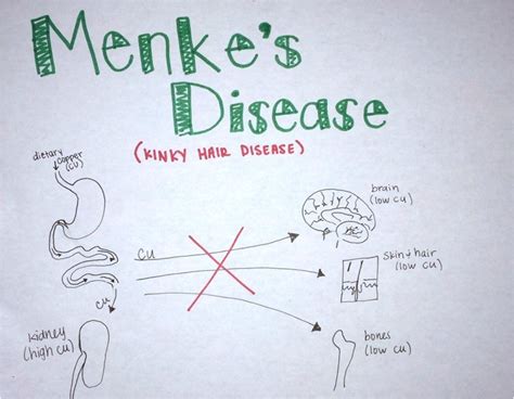 Overview Menkes Disease