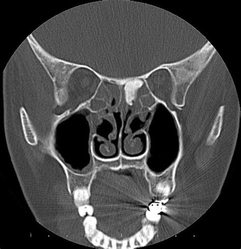 A Rare Case Of Sinolith In The Ethmoid Sinus Eurorad